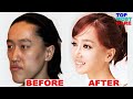 50 Korean Plastic Surgery Before and After Photos