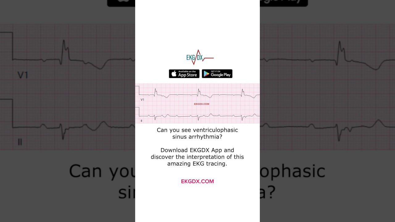 Install the EKGDX App to Master ECG Interpretation!