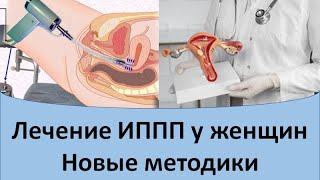 Лечение ИППП у женщин# Новые методики