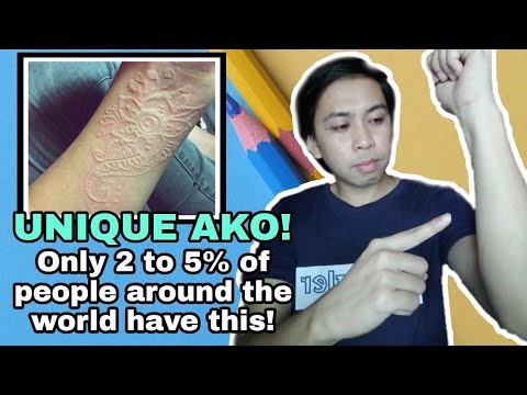 Pinoy living with Skin Writing also known as Dermatographic Urticaria (2021 tagalog)
