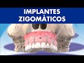 Implantes ZIGOMÁTICOS - Como colocar implantes em pacientes com pouco osso ©