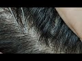 Relaxing dandruff removal compilation 13 02sleepyheads  visual asmr to relax your mind satisfying