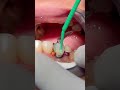 Rebuild old composite restoration with fiber post #dentist #dental #dentistry #reels #dentalhealth
