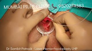 Live surgery || Laser Hemorrhoidoplasty LHP || Best Laser piles surgery || Dr Sambit Patnaik
