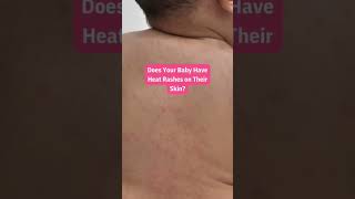 Does Your Baby Have Heat Rashes On Their Skin