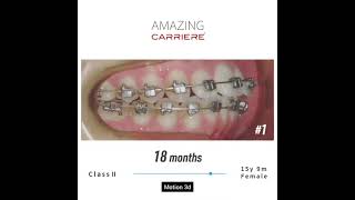 Досвід лікування апаратом Carriere Motion 3D №1 #AmazingCarriere