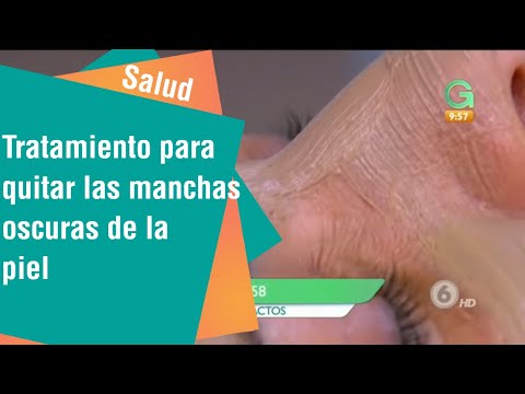 Vídeo: Crioterapia Para Metástase Nodal Em CPNPC Com Resistência Adquirida à Imunoterapia