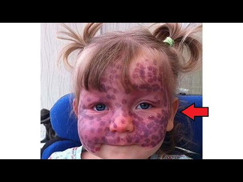 Video: Zdravlje za bebe A-Z: Impetigo