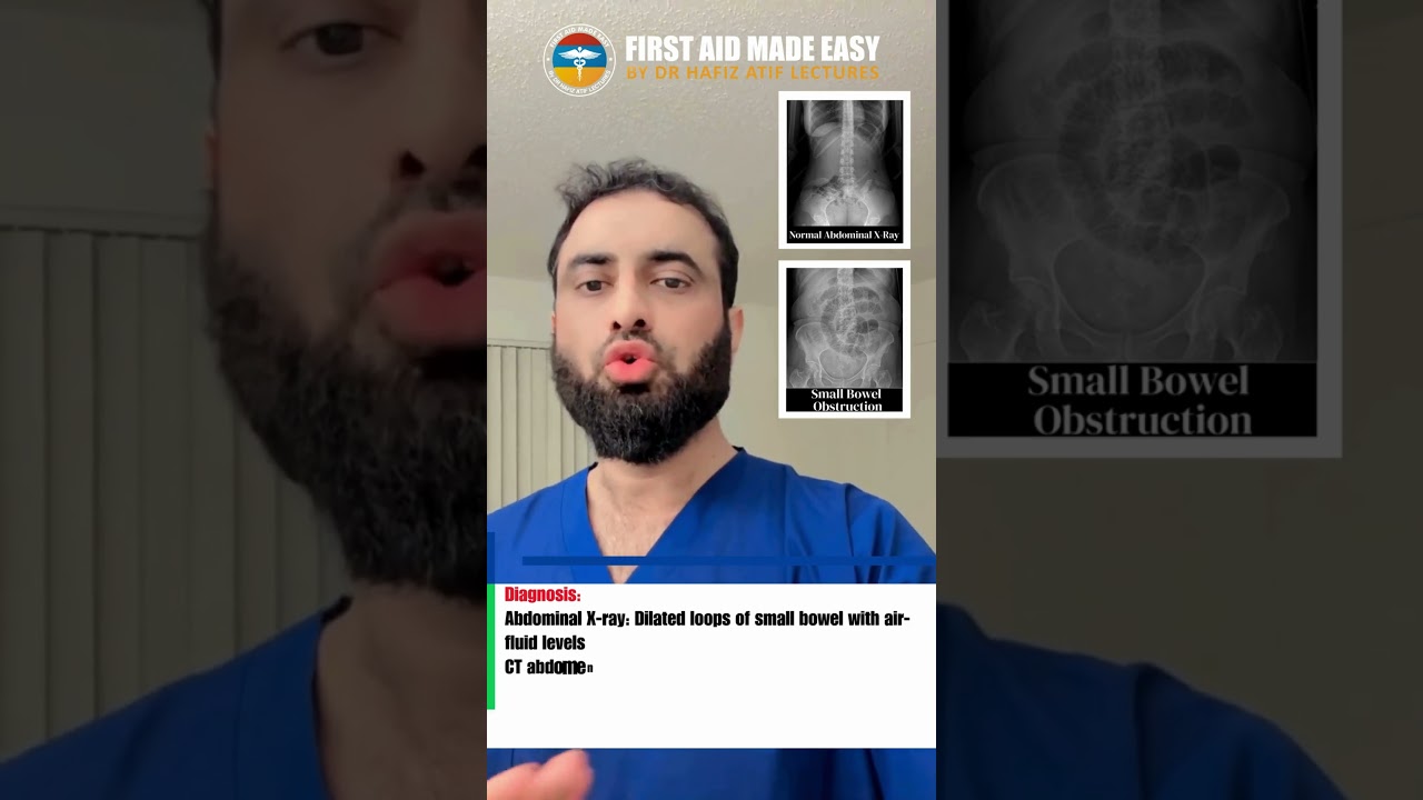Small Bowel Obstruction | Exam Key Points | Dr Hafiz Atif | FAME Platform #FCPS #NRE #GIT