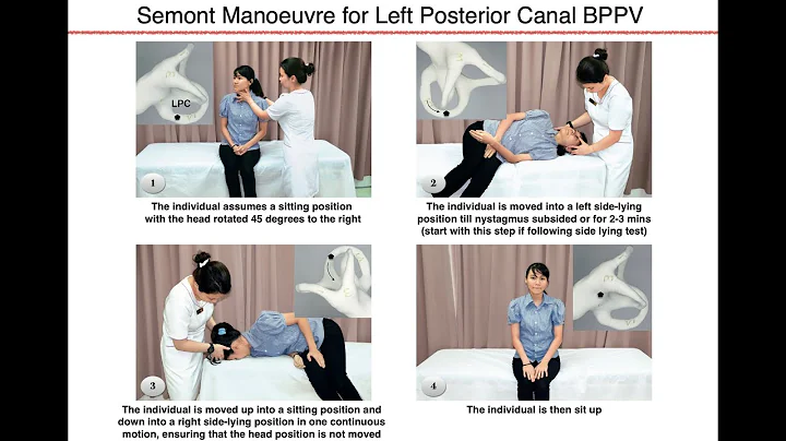 Semont Manoeuvre for Left Posterior Canal BPPV