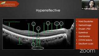 Webinar 3. How to read a Retina OCT. Dr.Chaitra Jayadev screenshot 2