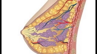 خراج الثدى د.محمد جاد  breast abcess #الثدى