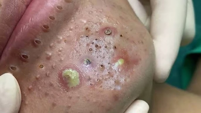 Big Cystic Acne Blackheads Extraction Blackheads & Milia, Whiteheads  Removal Pimple Popping # 3861 - YouTube