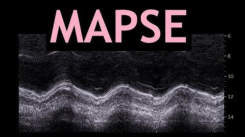 How to measure MAPSE: Echocardiography!