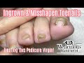 👣Squeezed Ingrown Toenail Pedicure How To Transformation👣