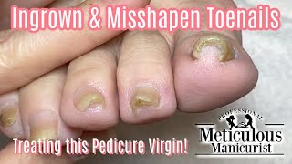 👣How To Transformation Squeezed Ingrown Toenail Pedicure 👣