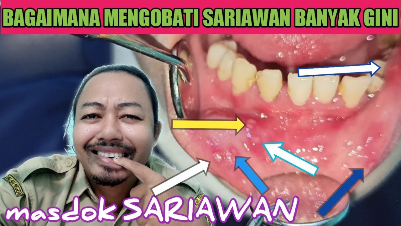 sariawan di bibir sebanyak ini pasti ngga nyaman sekali,bagaimana cara