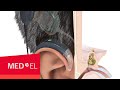 Wie funktioniert ein cochleaimplantat  medel