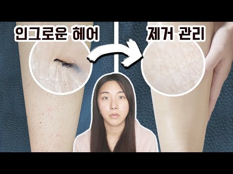 심한 다리털 인그로운헤어 없앤 홈케어 방법 소개해요(원인,염증,관리,뽑기,제거,방지)