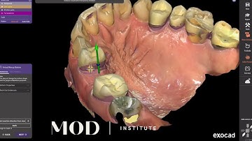 Monolithic 3D printed partial design in exocad