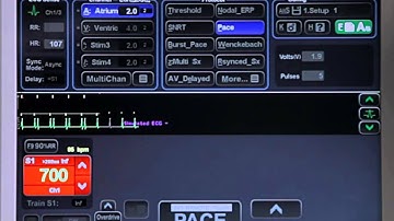 2D - Basic Pacing - High Impedance
