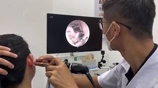     कान बंद? देखें सबसे बेहतरीन सफाई प्रक्रिया 👂 #EarwaxRemoval #Doctor #ENT 
