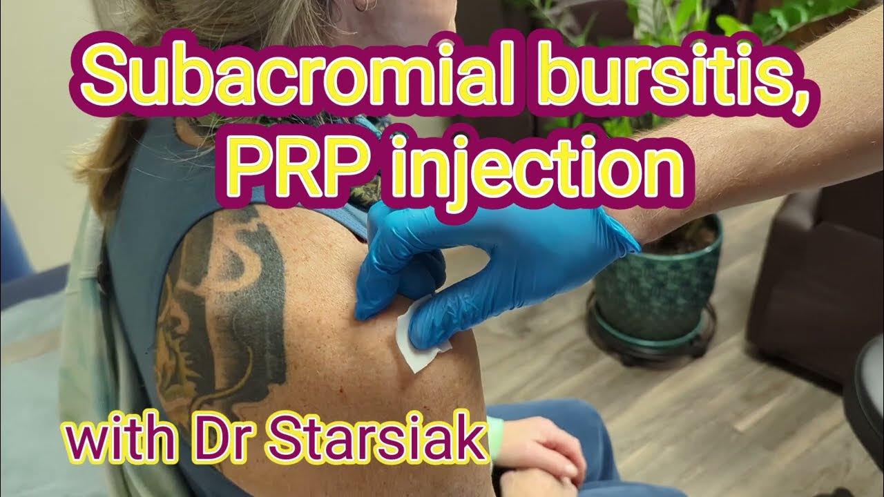 Subacromial Bursitis PRP injection YouTube