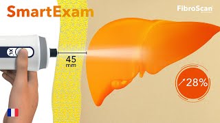 SmartExam pour une meilleure prise en charge des patients atteints de stéatose hépatique