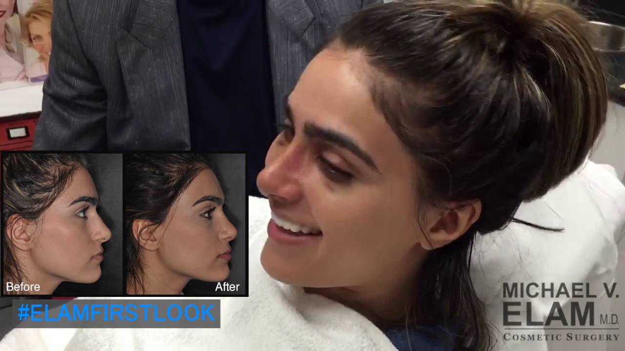 Septorhinoplasty, Rhinoplasty & More by Dr. Michael Elam - 