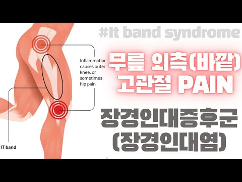 (무릎 바깥 통증)장경인대염/장경인대증후군 치료 방법(IT Band Syndrome Stretches & Exercises)