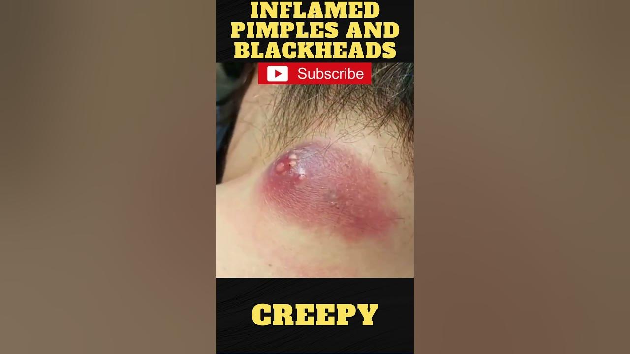 Giant Pimple Explosion Cyst Popping Acne Pus Blackheads Bursting