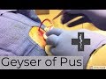 Big Geyser of Pus from a deep large arm abscess