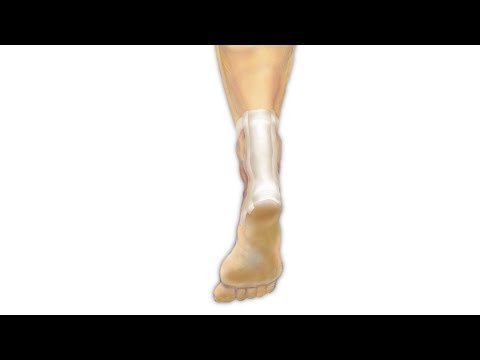 Achilles Tendon Repair Surgery PreOp® Patient Education