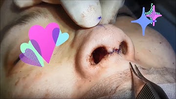 비밸브 교정술 (비밸브 재건술, 비밸브 성형술, nasal valve surgery)