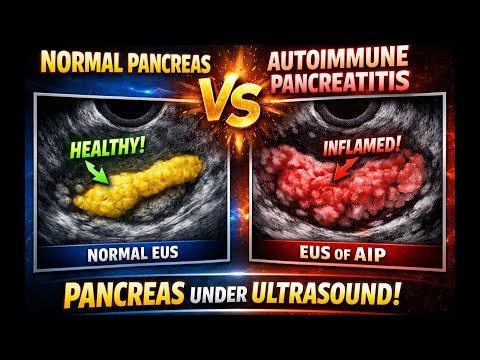 Iga Deficiency Pancreatitis