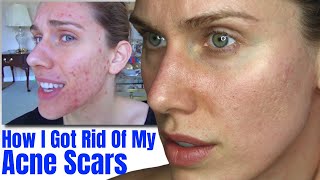 Acne + Scar Update (How I Got Rid Of My Acne Scars)