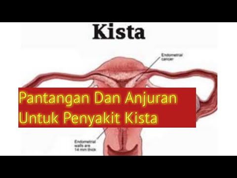 Pantangan Penyakit Kista Dan Anjuran Makanan Untuk Penderita Kista