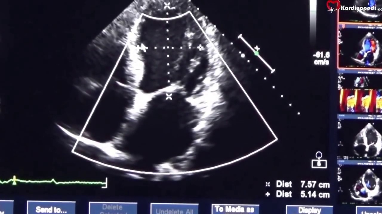 fonksiyonel mitral yetersizliği değerlendirilmesi