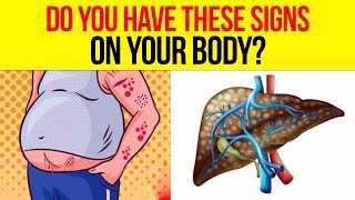 10 Signs You Have A FATTY LIVER Fatty Liver Warning Signs