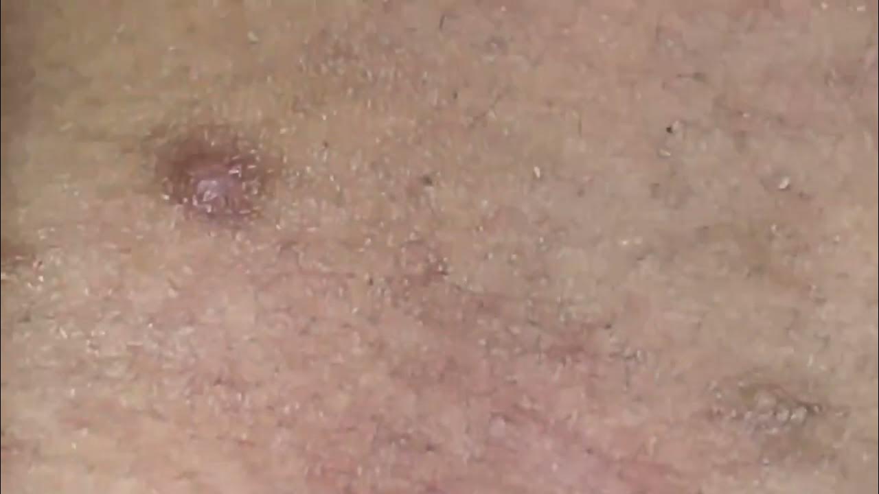 Satifying Blackheads Removal Blackhead extraction enilsa brown 