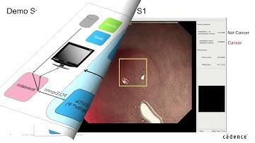 Computer Aided Diagnosis System using Tensilica Vision P6 DSP