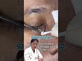 【稗粒腫の保護テープ】寄生虫のような大きさの牌粒腫！摘出後の丁寧な処置にたかし先生も思わずにっこり！