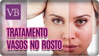 Vermelhas meu rosto são essas pequenas quais veias no