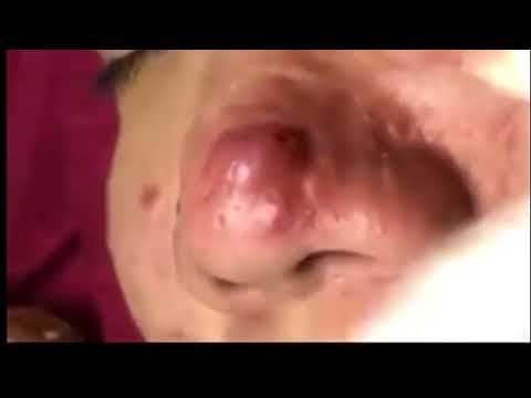 Big Infected Cystic Acne Removal On Nose!! Please