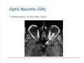 Visual Involvement in MS: Optic Neuritis and Optical Coherence Tomography