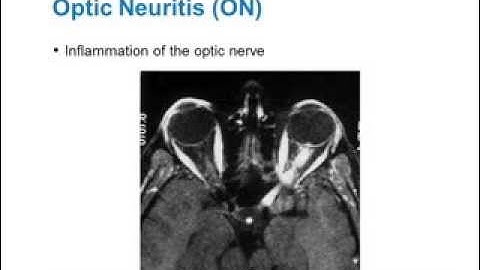 Visual Involvement in MS: Optic Neuritis and Optical Coherence Tomography