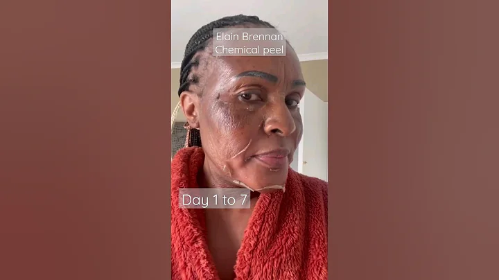 Chemical peel, day 1 to 7 , skin Resurfacing #foryou #shorts #shortvideo