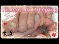 👣 Pedicure Tutorial How to Cut and Shape Pincer Toenails at Home  👣