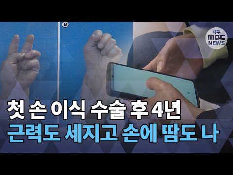 [대구MBC뉴스] &quot;4년 추적 손 이식 성공적&quot;..국내 두 번째 수술