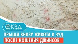 👉 Прыщи внизу живота и зуд после ношения джинсов. Клинический случай №689